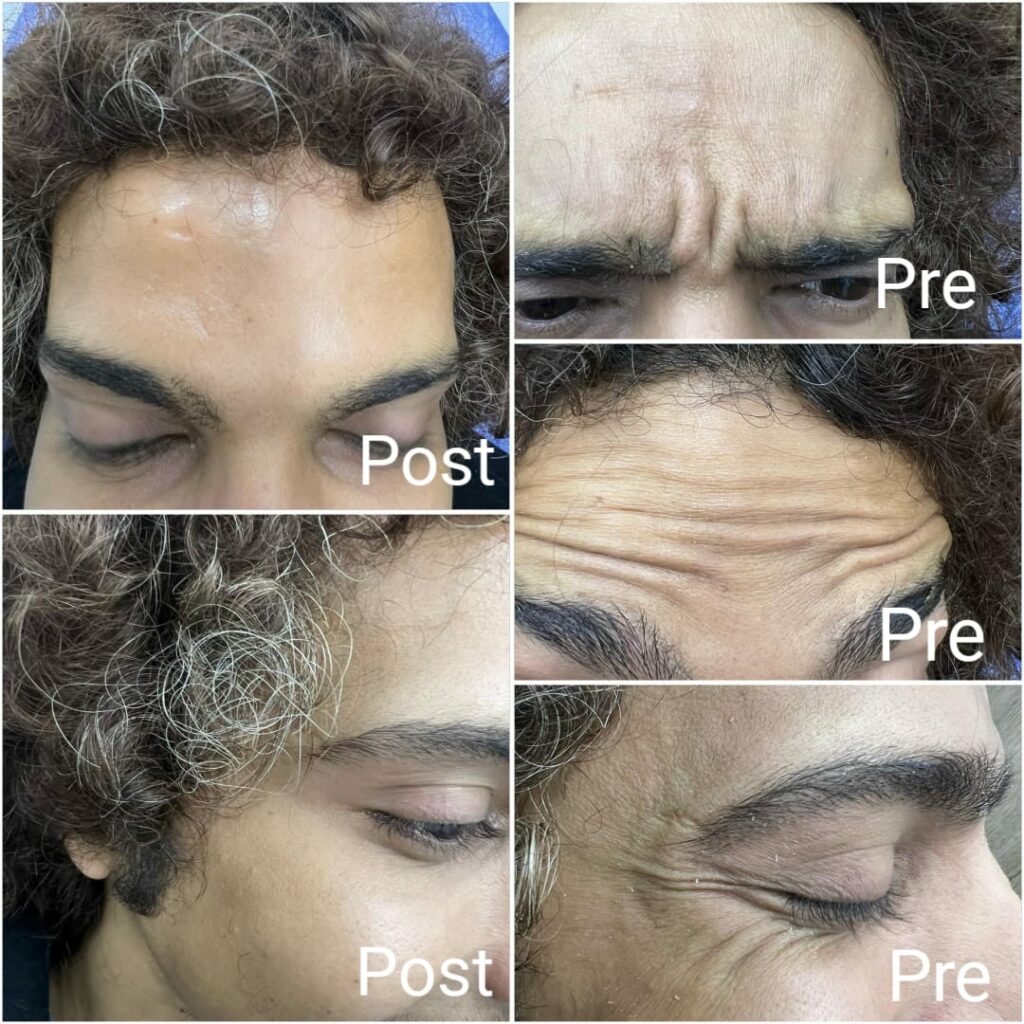 Botox results for facial wrinkles