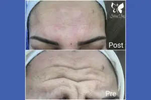 Forehead wrinkles treatment in Hurghada