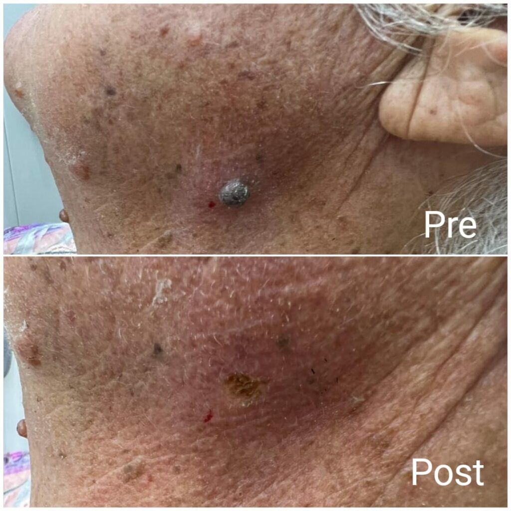 Seborrheic keratosis removal before and after