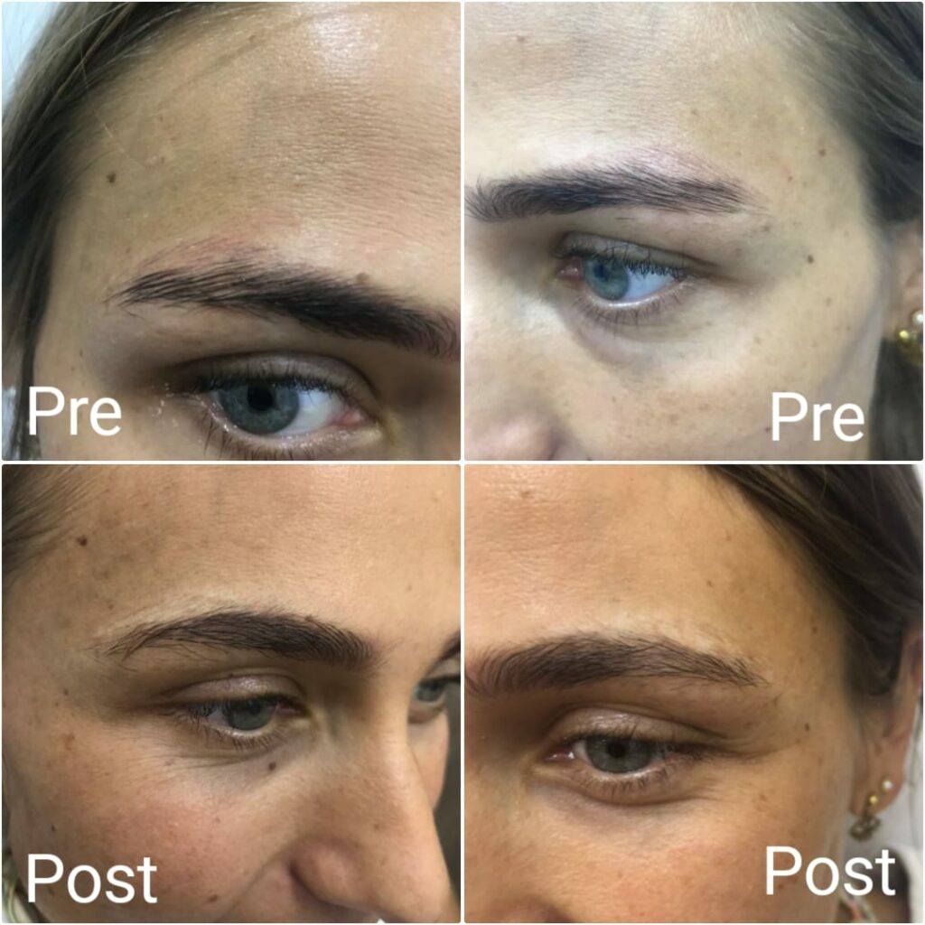 Eyebrow tattoo removal before and after