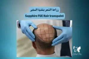 Sapphire FUE hair transplant in Hurghada