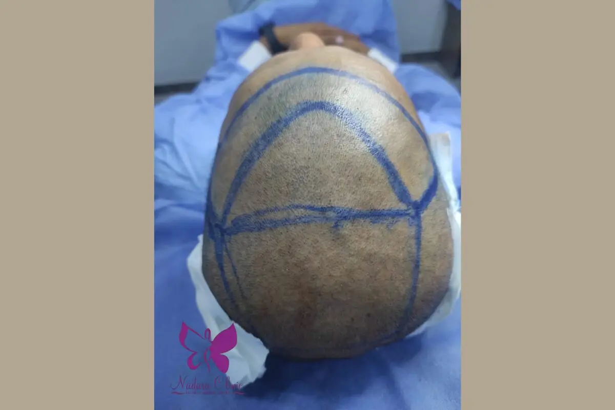 Sapphire FUE hair transplant in Hurghada