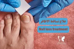 Nail loss treatment in Hurghada