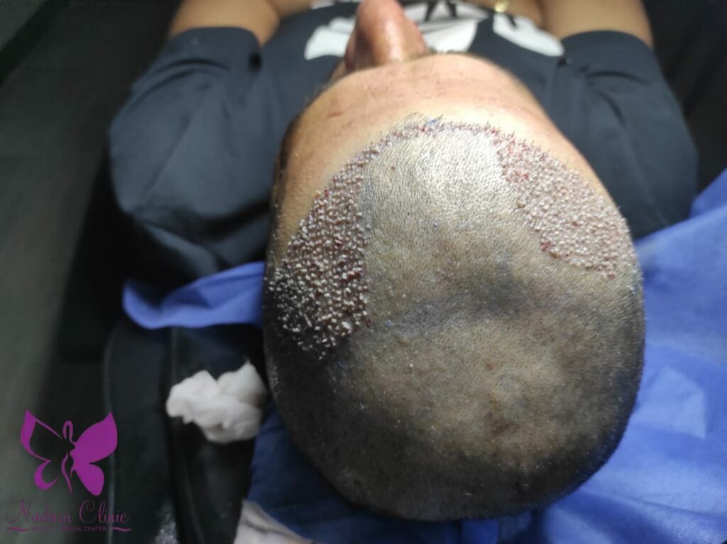 Hair transplantation for the v area forehead