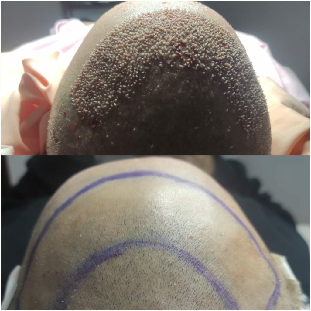 Result of frontal and hairline transplantation