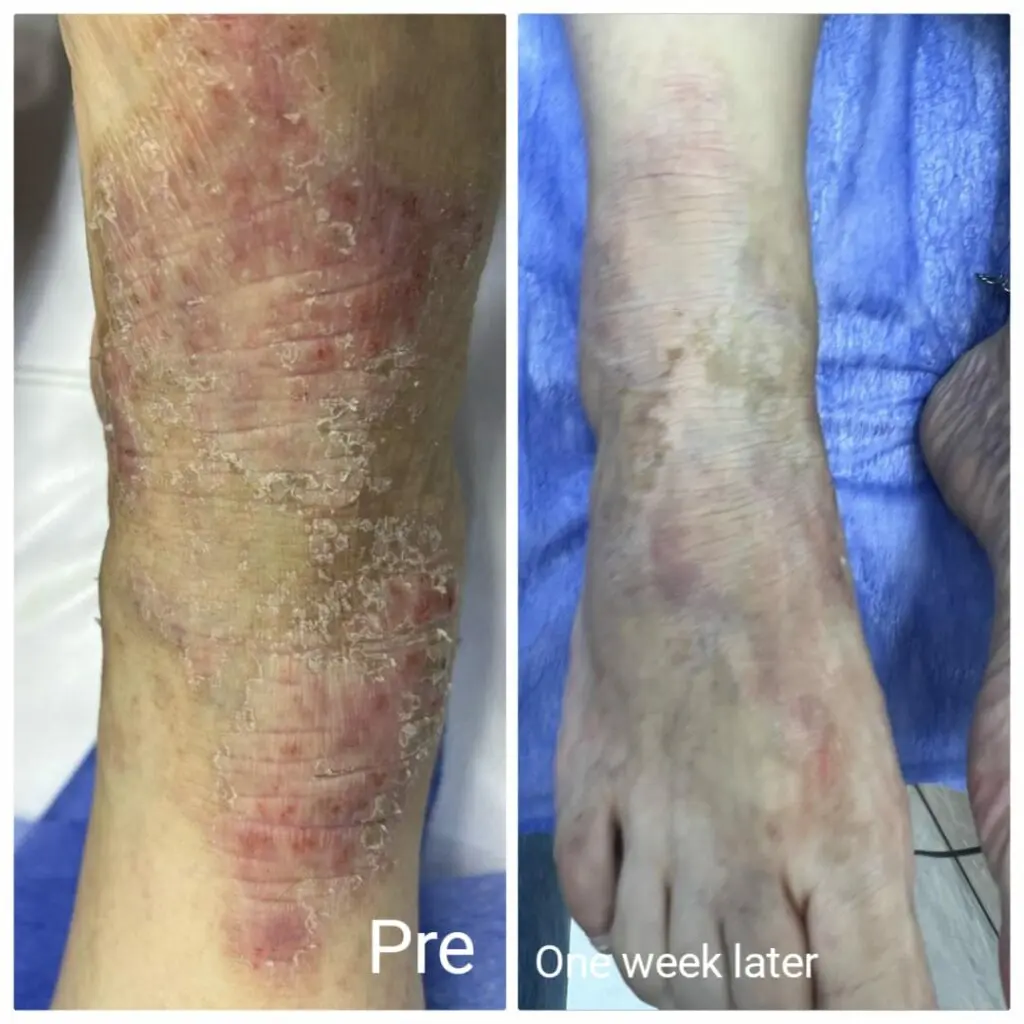 Eczema treatment before and after