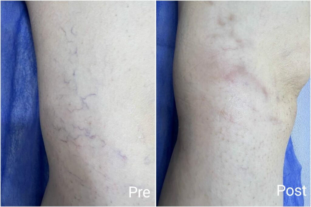Varicose veins treatment before and after