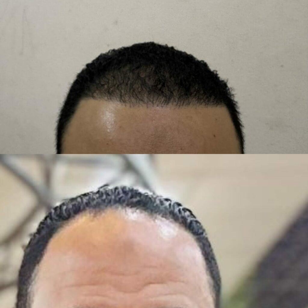 نتائج زراعة الشعر بتقنية السفير قبل وبعد