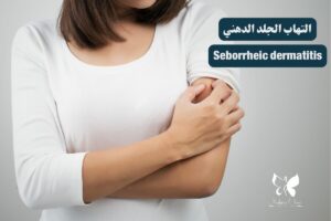 Seborrheic dermatitis in Hurghada