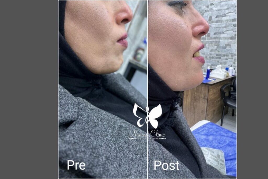 Chin filler in Hurghada