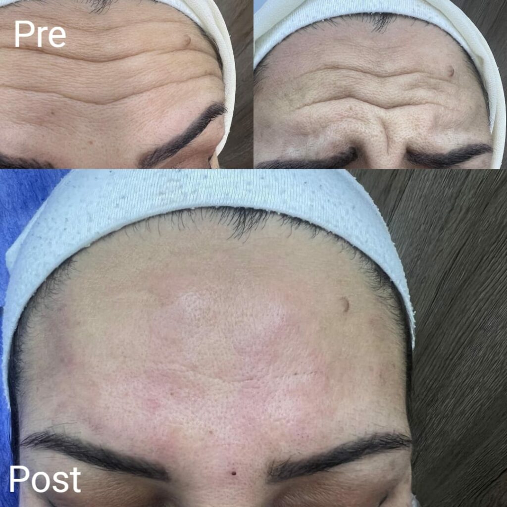 Removing forehead lines with Botox