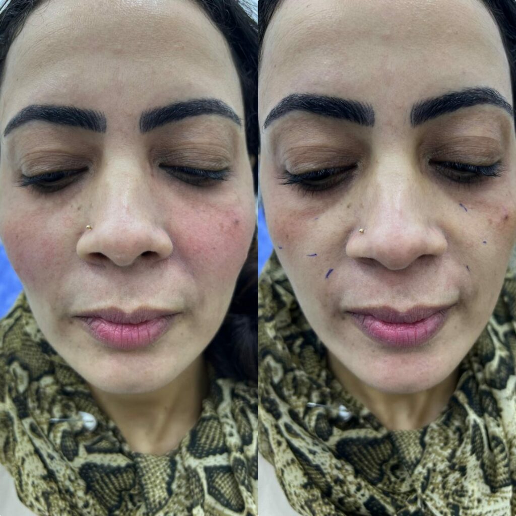 Facial and cheek beautifying in Hurghada