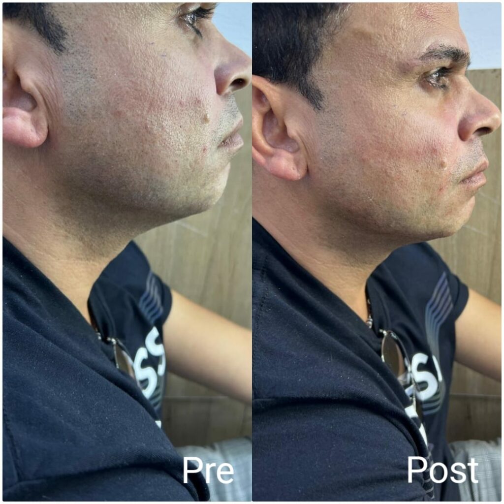 Jaw definition with filler for men