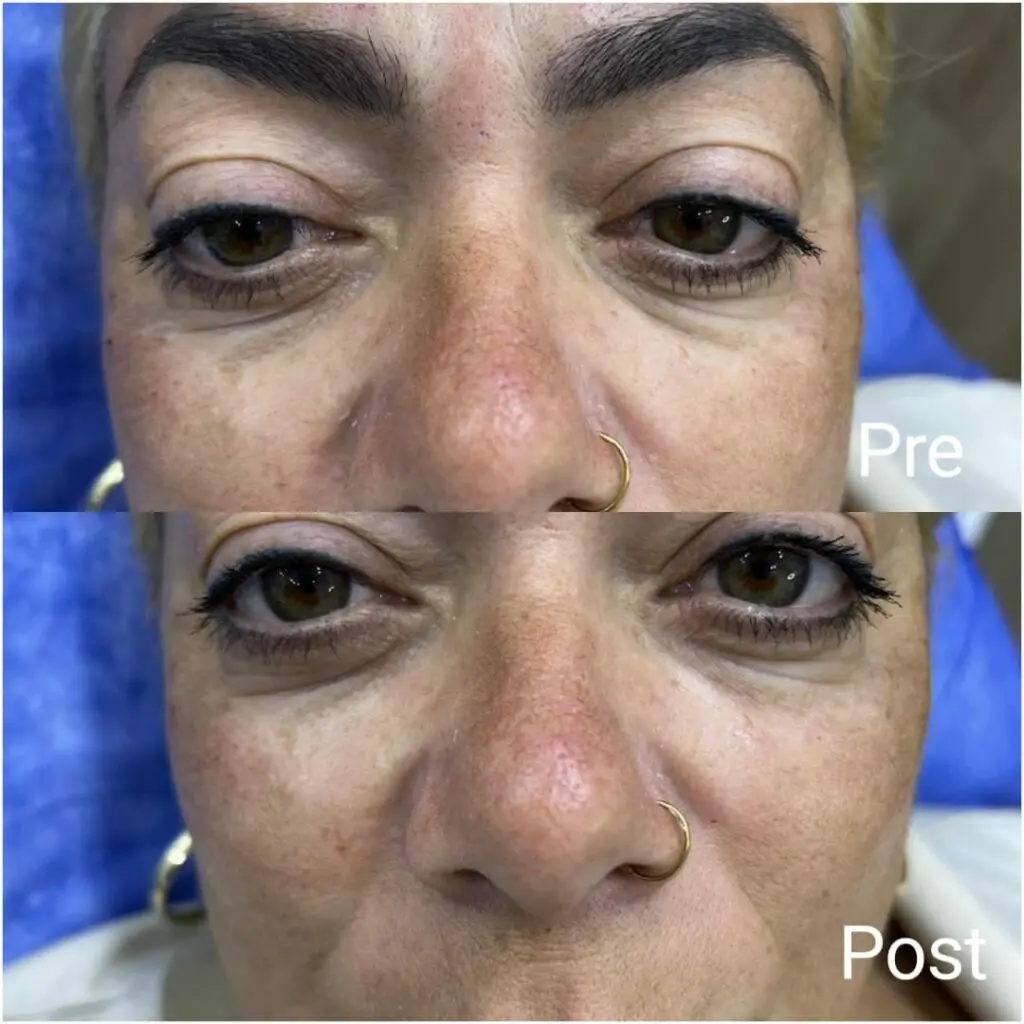 Improving the appearance of under the eyes for women before and after