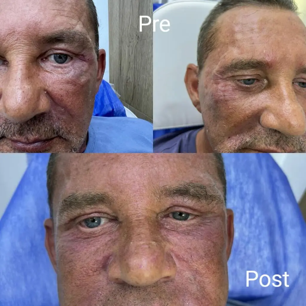 Improving the appearance of around the eyes with fillers for men before and after