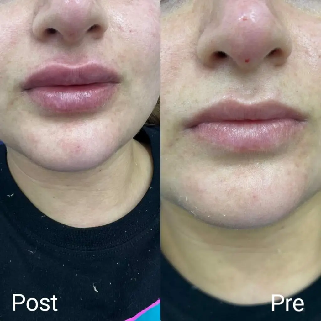 Lip augmentation with filler before and after