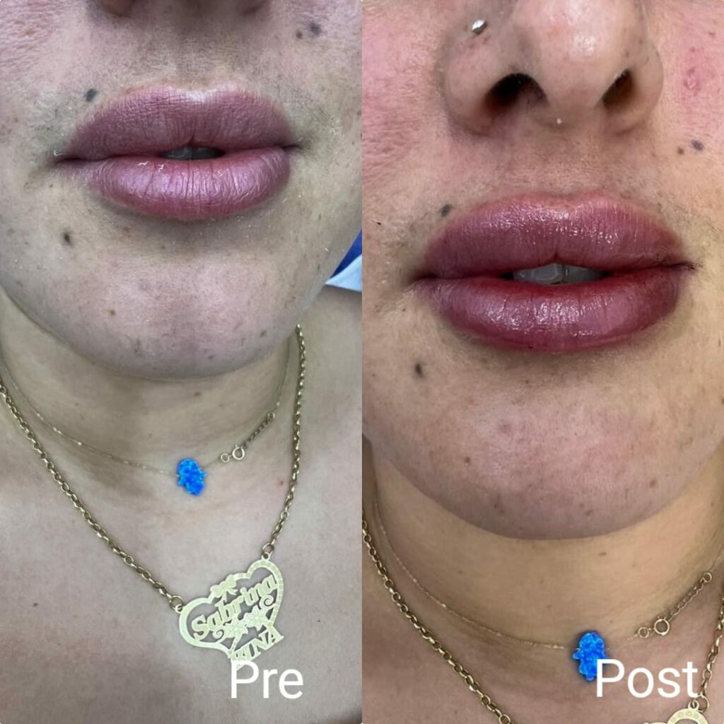 Lip augmentation with fillers