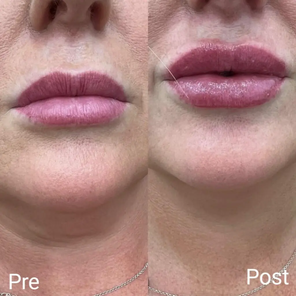 Lip filler injections