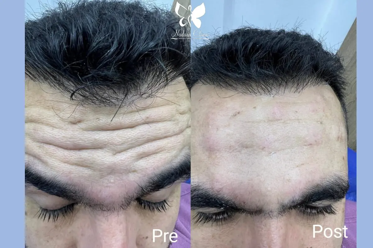 Botox Injection Center in Hurghada - Book Now - Nadara Center