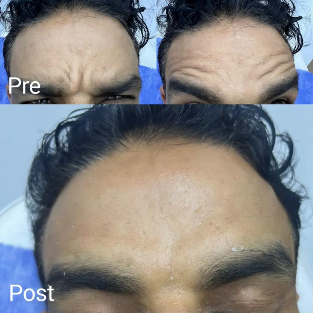 Botox injections for men before and after