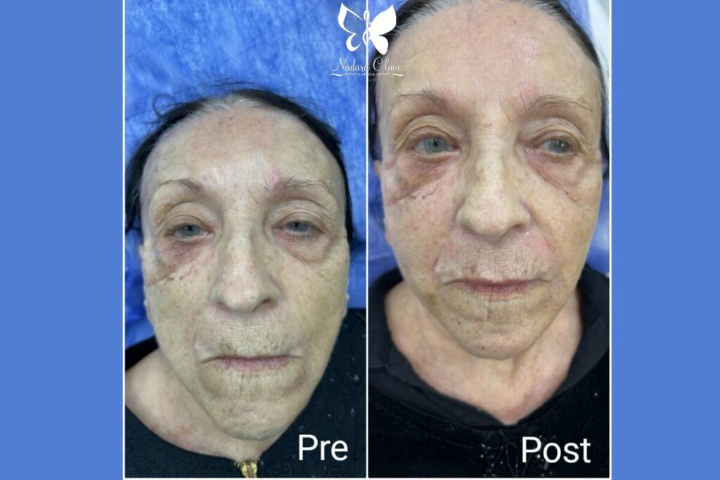 Filler injection center in Hurghada