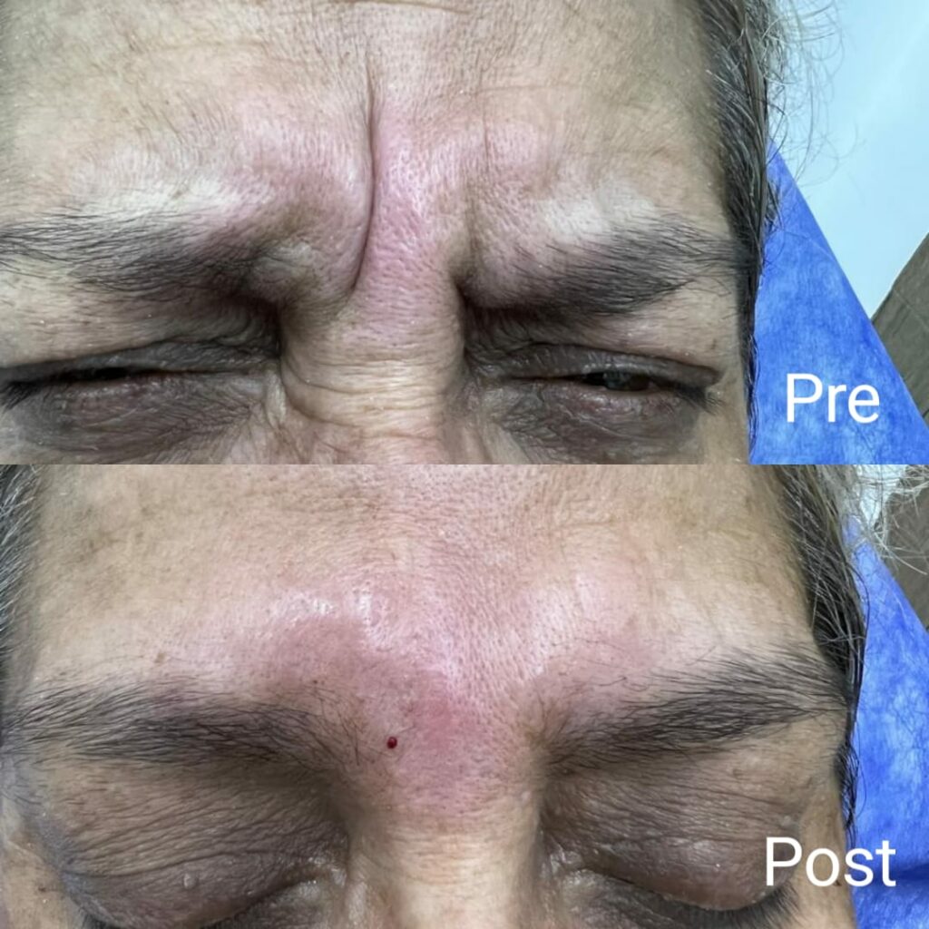 Hiding Botox signs of anger before and after