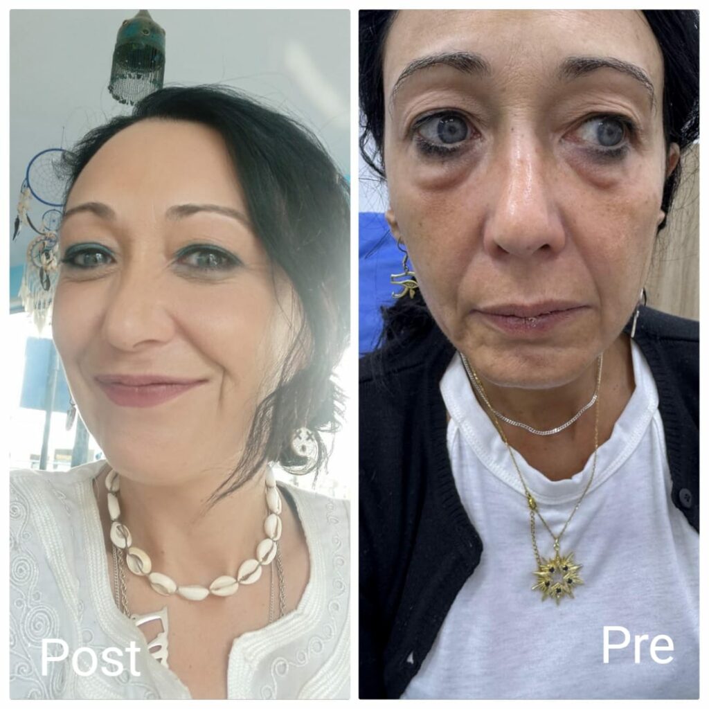 Facelift threads before and after