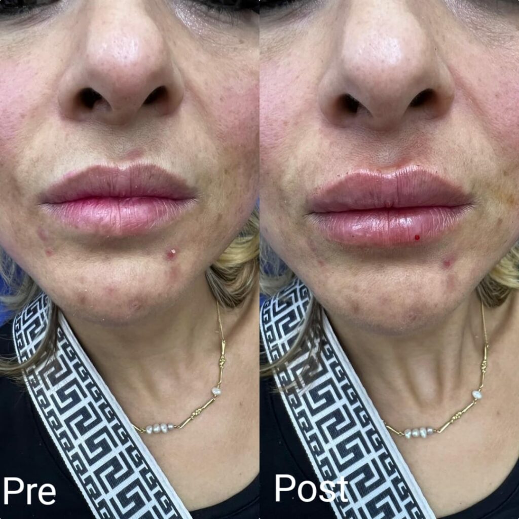 Lip filler before and after