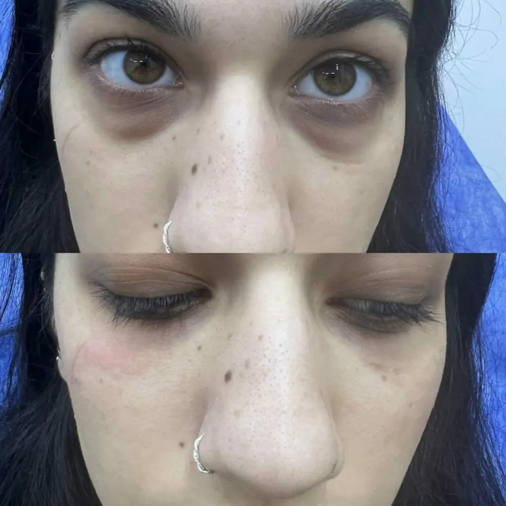 Filler under the eye, medical tourism in Hurghada