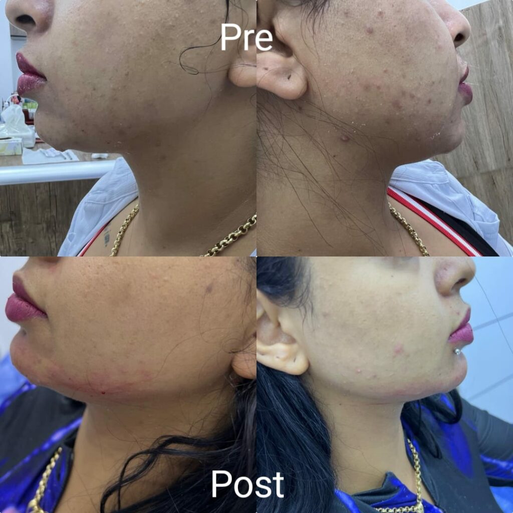 Jaw contouring filler before and after