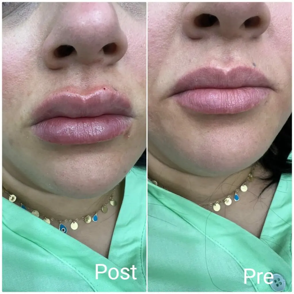 Lip contour with filler
