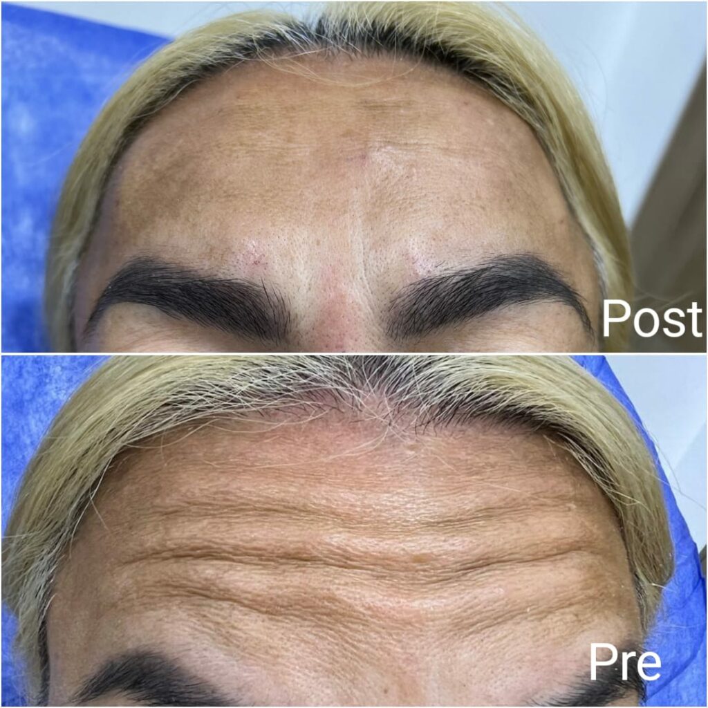 Facial Botox before and after