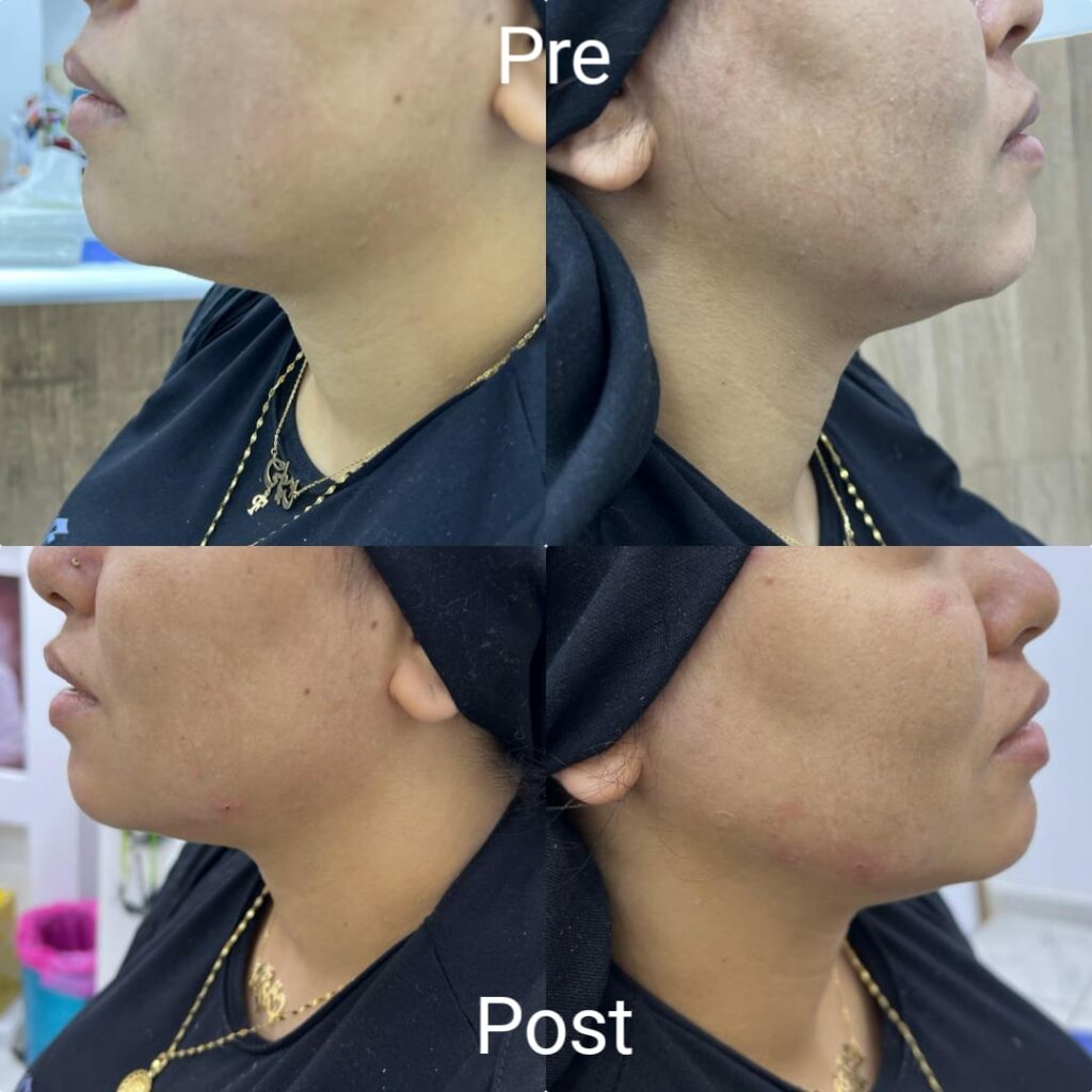 Jaw sculpting with filler before and after
