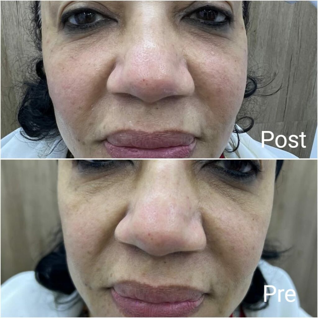 Cheek plumping with filler before and after