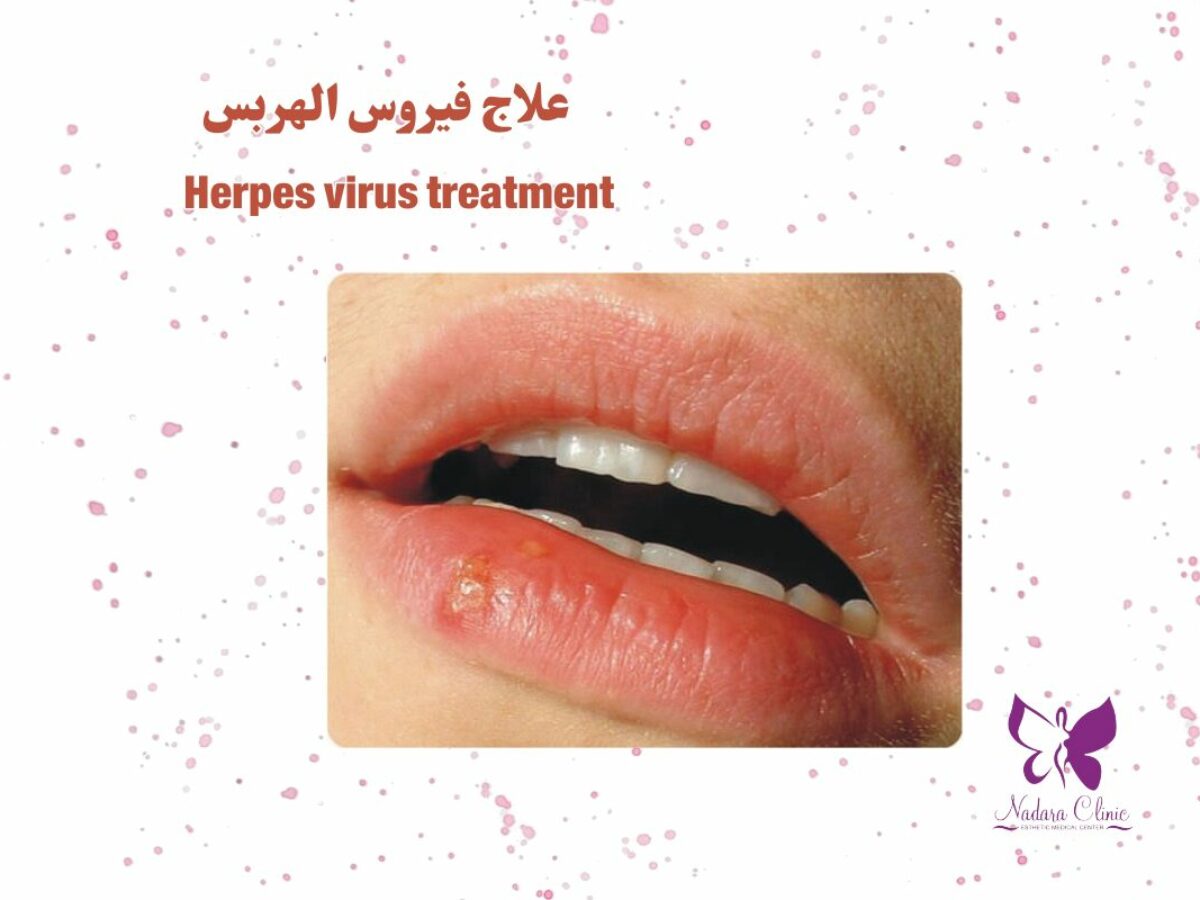 Herpes Virus Treatment in Hurghada - Book Now - Nadara Center, image size:1200x900