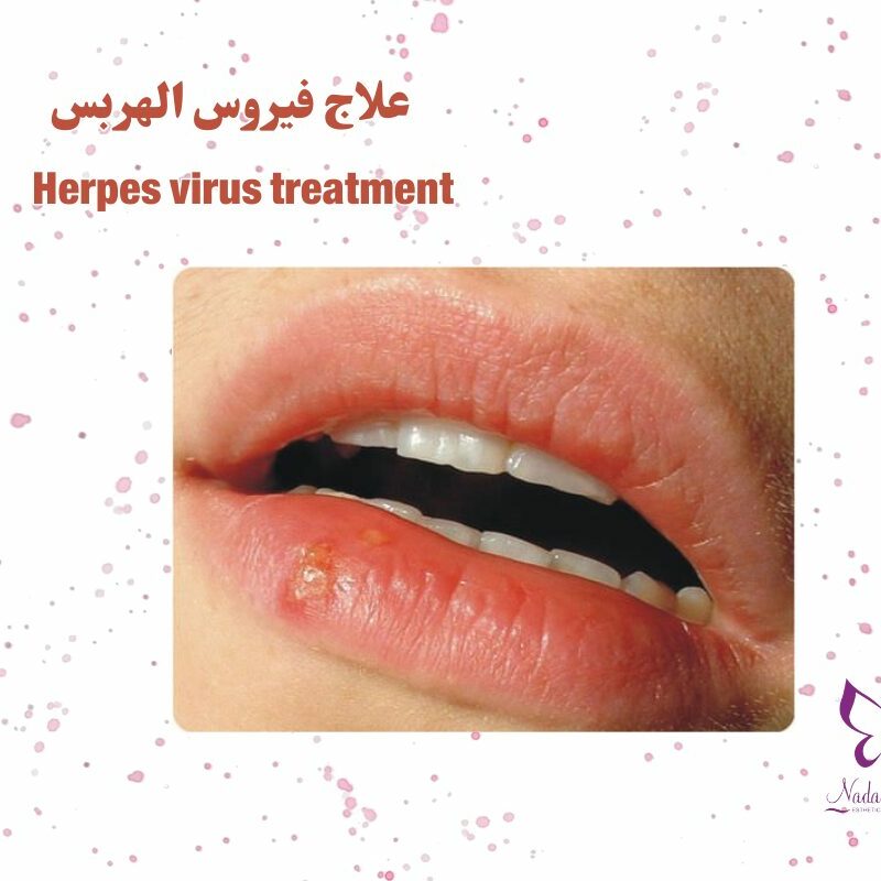 can you catch herpes from cigarettes Viral Skin Infection: gladiatorum ("Mat Herpes") Herpes Virus Treatment in Hurghada