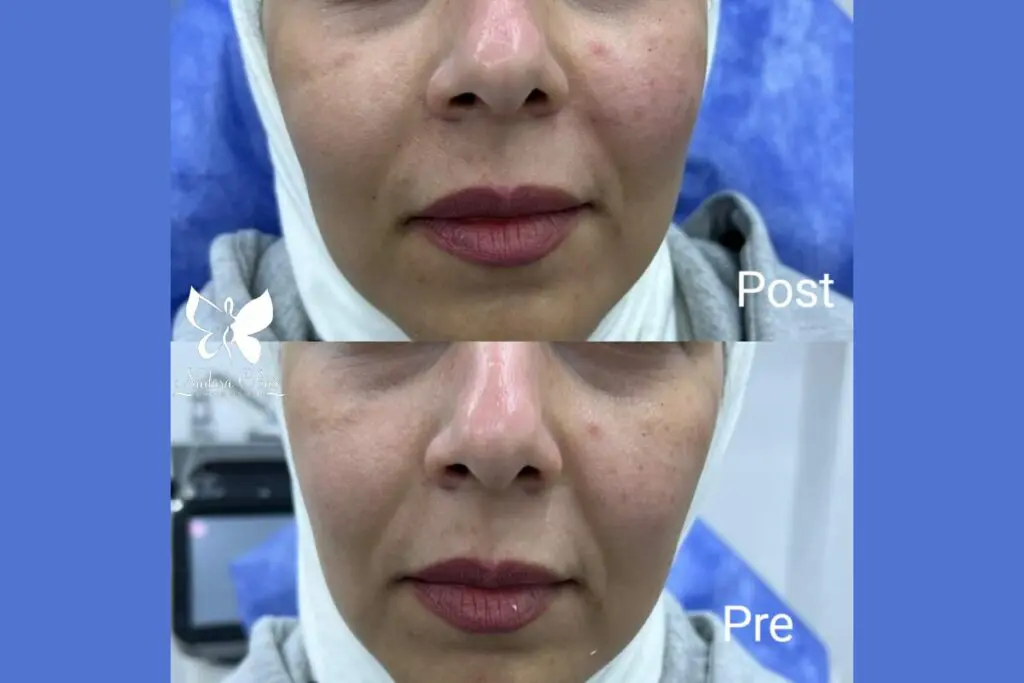 Cheek fillers in Hurghada