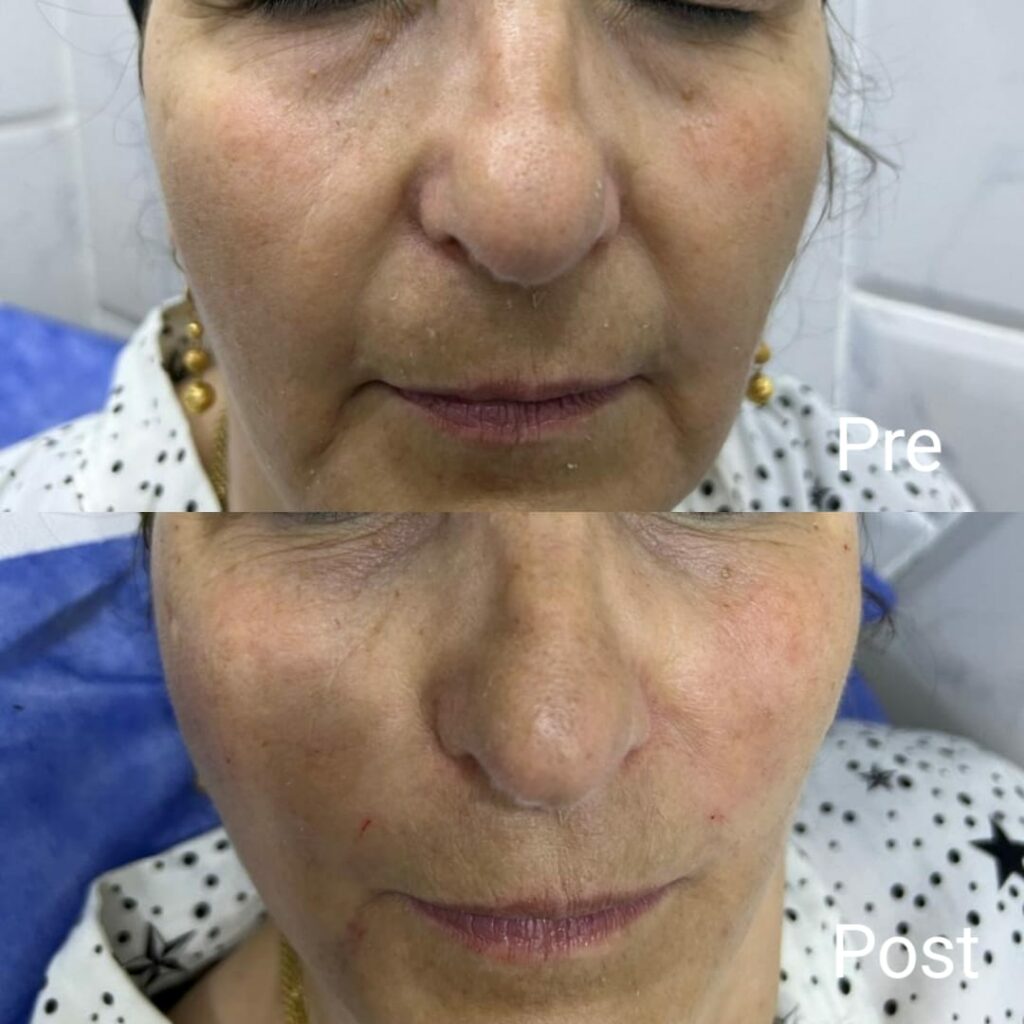 Cheek and smile line fillers