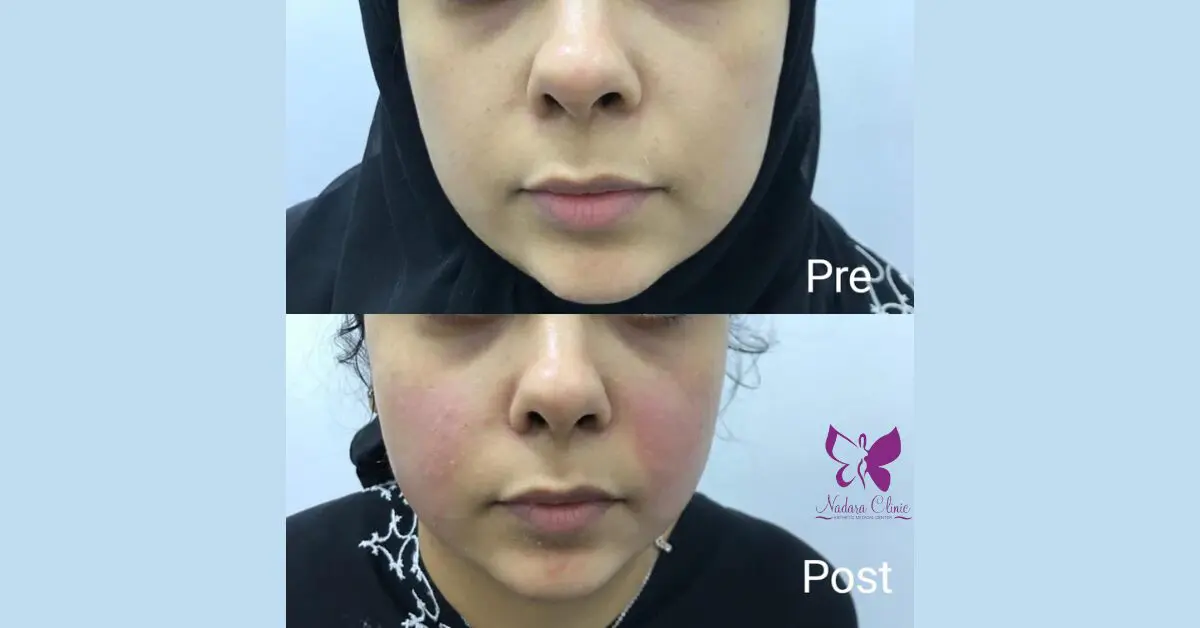 Facial mesotherapy in Hurghada