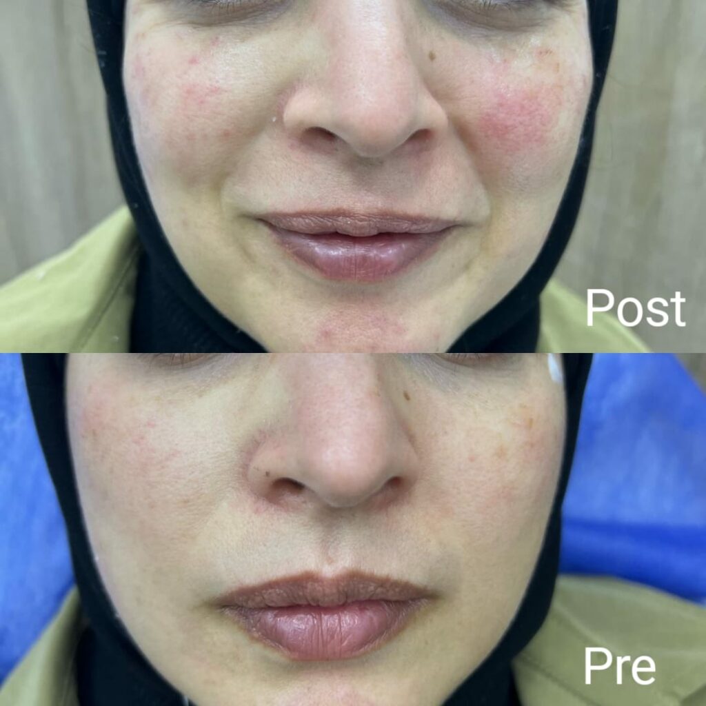 Facial mesotherapy before and after