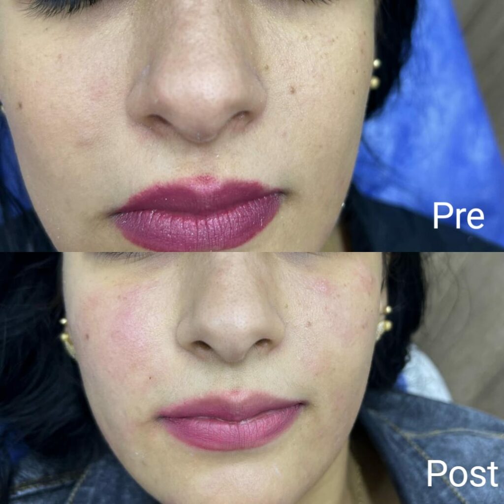 Facial mesotherapy results