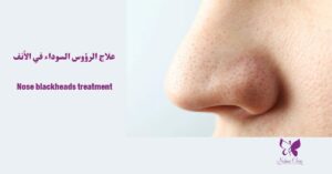 Nose blackheads treatment in Hurghada