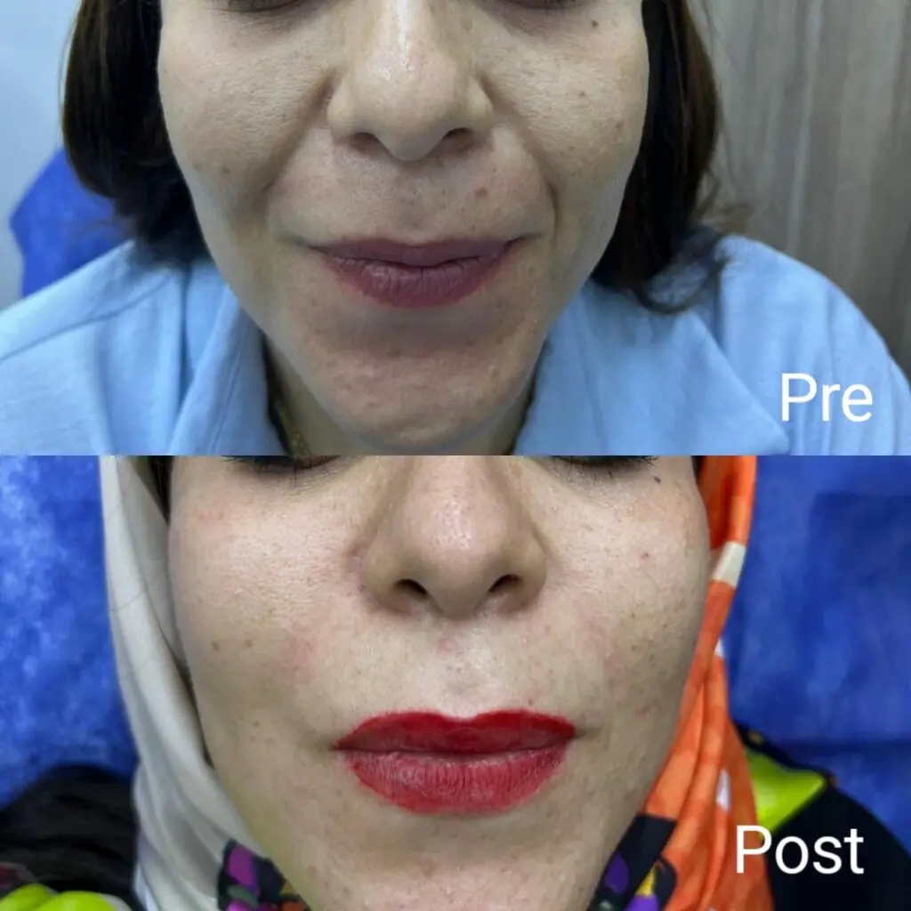 Olidia injection before and after