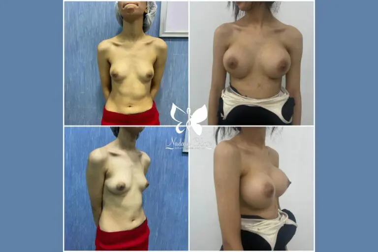 Silicone breast augmentation in Egypt