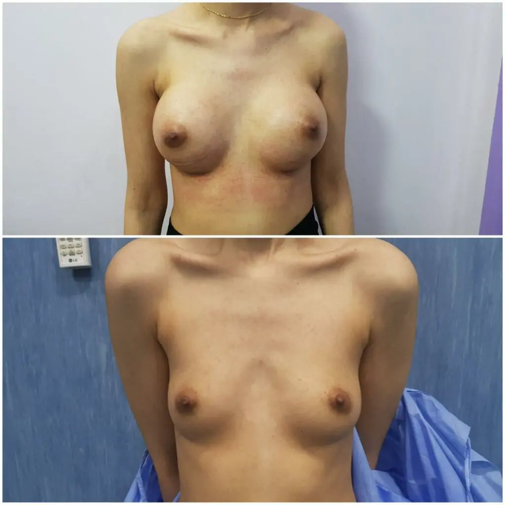 Silicone Breast Augmentation Surgery in Egypt