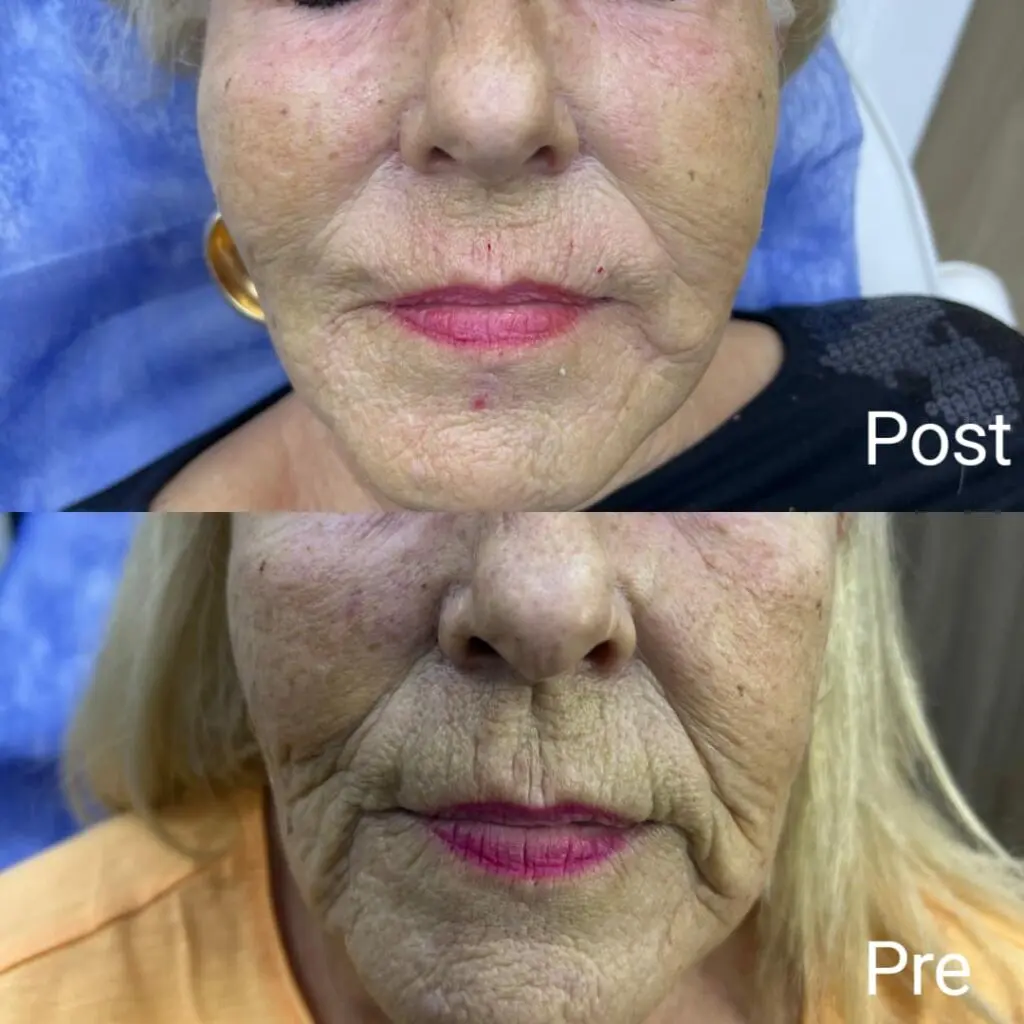 Anti-aging treatment before and after