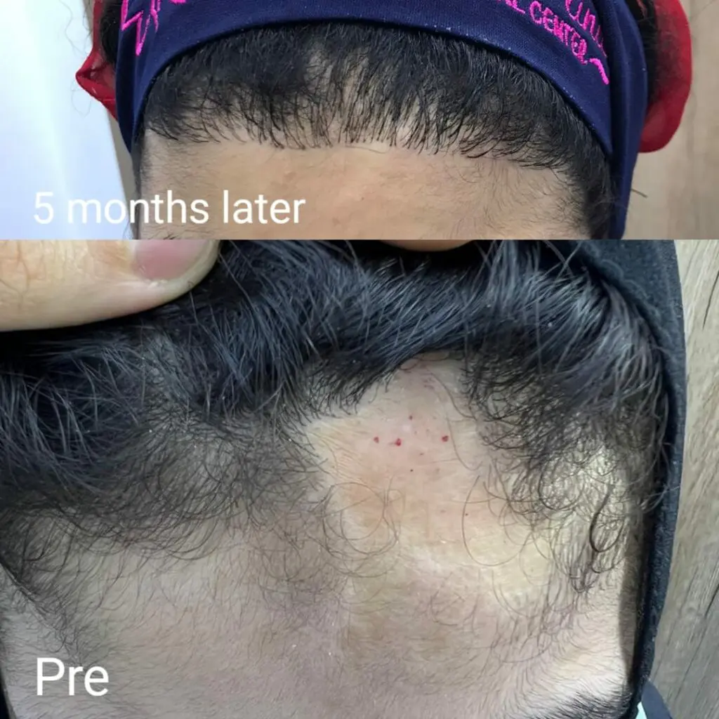 Scalp burn treatment in Hurghada