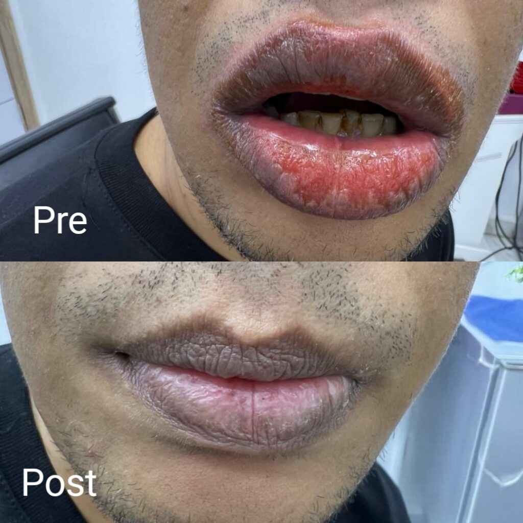 Lip fungus treatment before and after