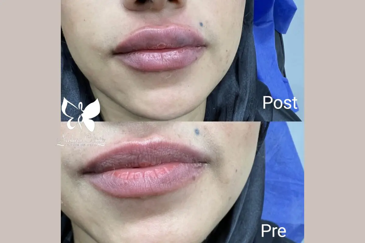 Lip filler injection in Hurghada