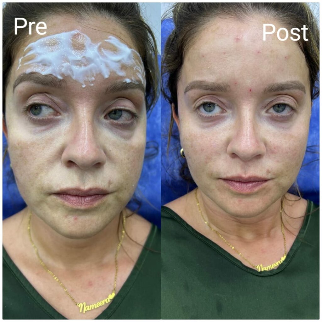 what size needle for glutathione injection Facial rejuvenation needles in Hurghada - Book now